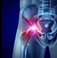 hip osteoarthritis