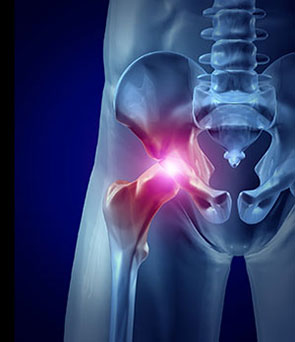 hip osteoarthritis